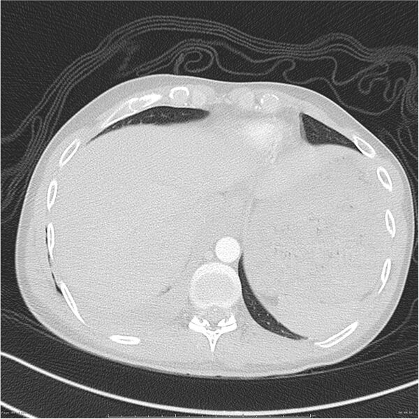 File:Chest and abdomen multi-trauma (Radiopaedia 26294-26425 lung window 88).jpg