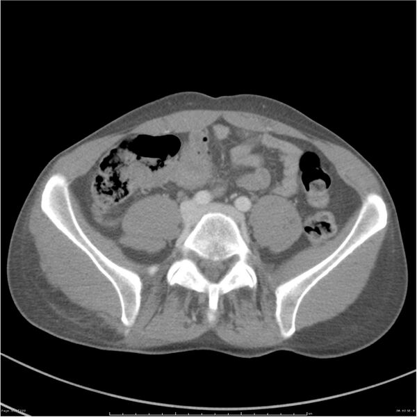 File:Chest and abdomen multi-trauma (Radiopaedia 26294-26426 A 60).jpg
