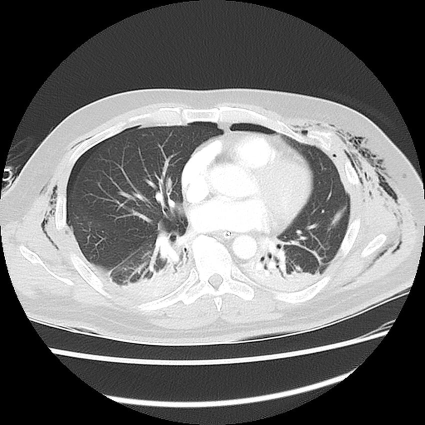 Chest crush injury (Radiopaedia 31620-32513 Axial lung window 33).jpg