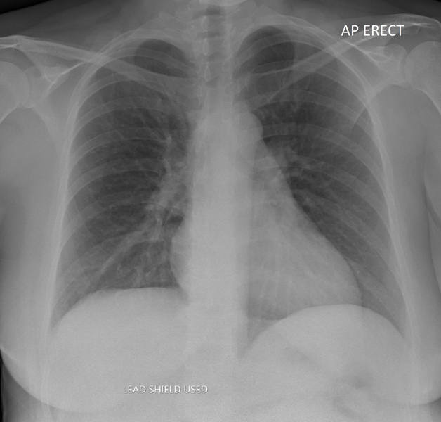 File:Chest x-ray in normal pregnancy (Radiopaedia 36714).png