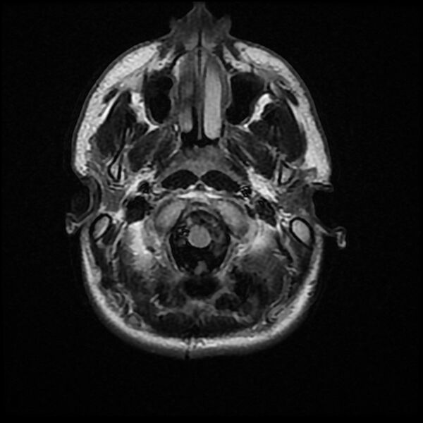 File:Chiasmatic-hypothalamic juvenile pilocytic astrocytoma (Radiopaedia 78533-91235 Axial FLAIR 4).jpg