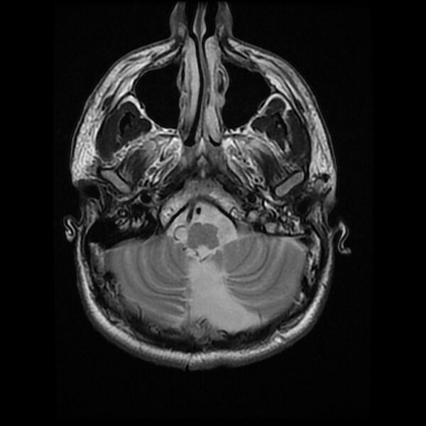 File:Chiasmatic-hypothalamic juvenile pilocytic astrocytoma (Radiopaedia 78533-91235 Axial T2 6).jpg