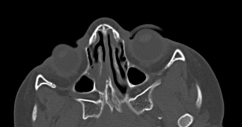 Choanal atresia (Radiopaedia 51295-56972 Axial bone window 33).jpg