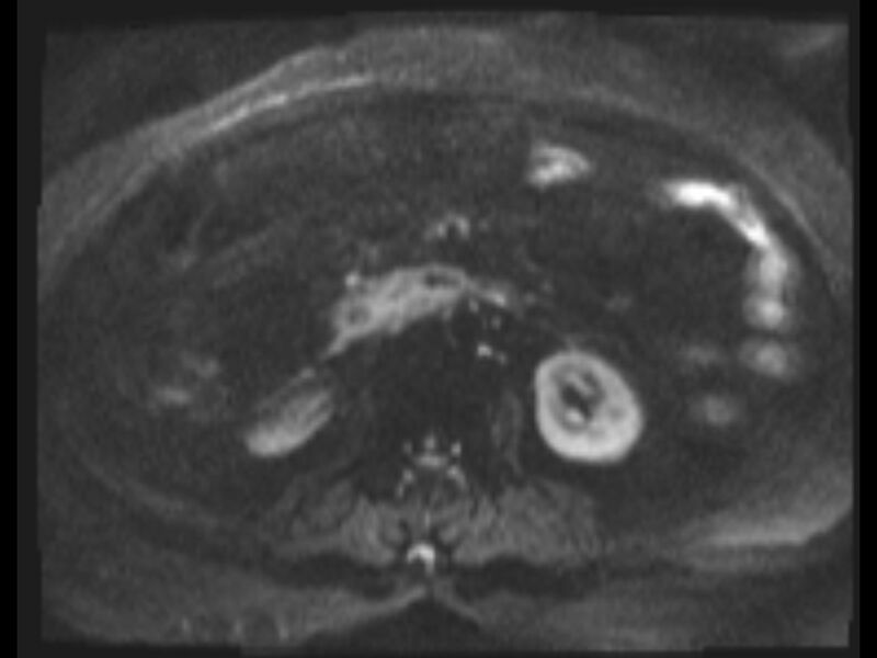 File:Choledocholithiasis causing intrahepatic biliary duct dilation (Radiopaedia 39908-42369 Axial T2 SPAIR 26).jpg