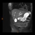 Cholelithiasis with biliary dilatation (Radiopaedia 49442-54589 Coronal T2 15).jpg