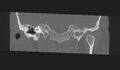 Cholesteatoma (Radiopaedia 10742-11203 Coronal bone window 5).jpg