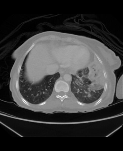 File:Chondrosarcoma (Radiopaedia 79427-92535 Axial lung window 42).jpg