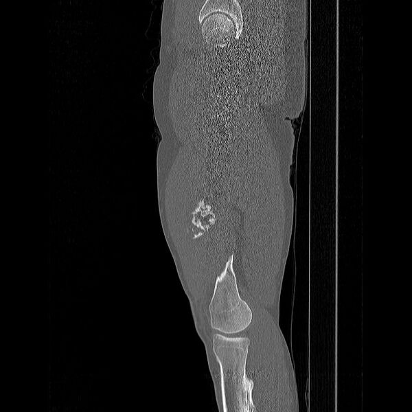 File:Chondrosarcoma arising from exostosis (Radiopaedia 59996-67507 Sagittal bone window 14).jpg