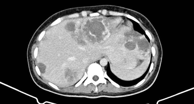 File:Choriocarcinoma liver metastases (Radiopaedia 74768-85766 A 39).jpg
