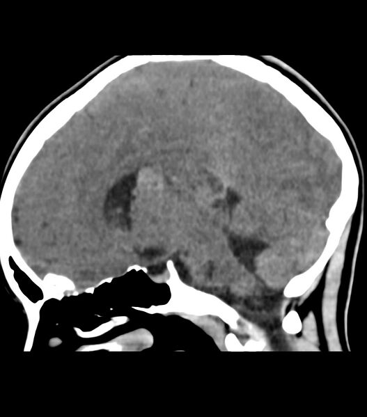 File:Choroid plexus carcinoma (Radiopaedia 91013-108552 B 35).jpg