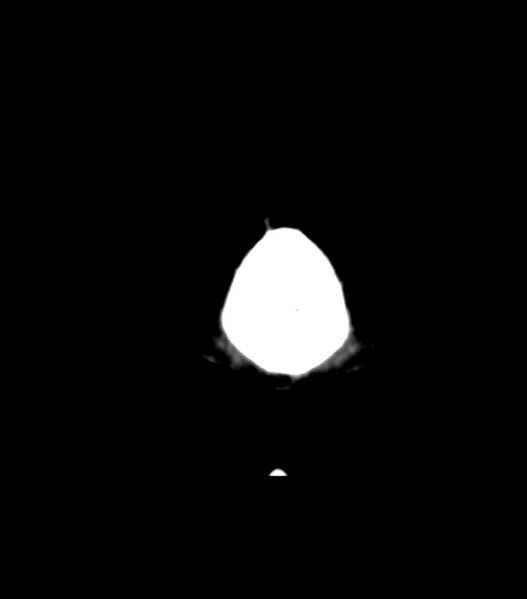File:Choroid plexus carcinoma (Radiopaedia 91013-108552 Coronal non-contrast 2).jpg