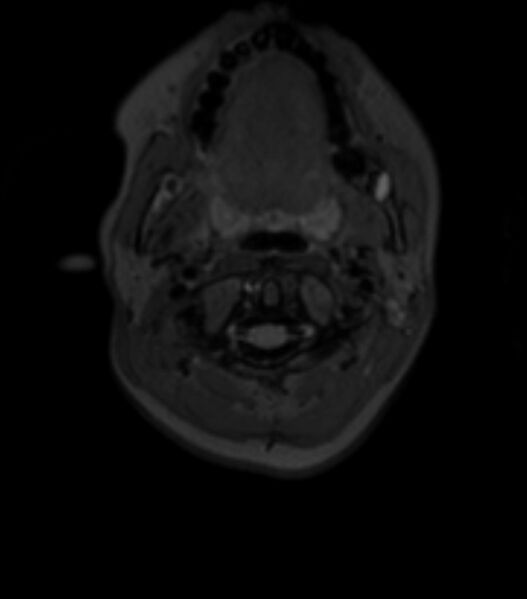File:Choroid plexus carcinoma (Radiopaedia 91013-108553 Axial T2 fat sat 11).jpg