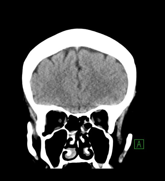 File:Choroid plexus xanthogranuloma (Radiopaedia 91271-108874 Coronal non-contrast 9).jpg