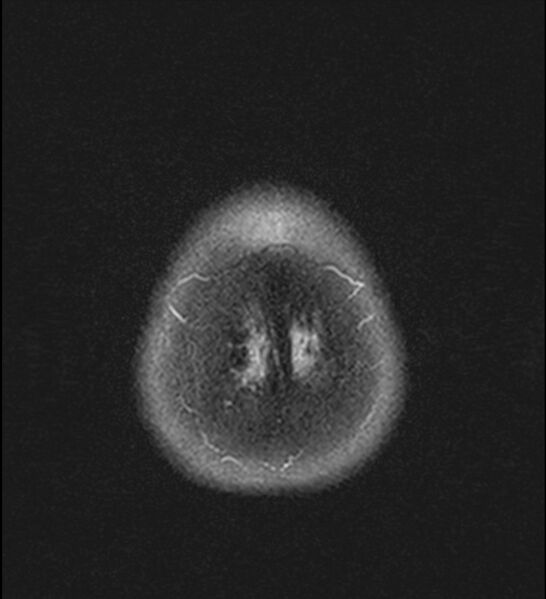 File:Choroid plexus xanthogranuloma (Radiopaedia 91271-108875 Axial T2 TIRM 27).jpg
