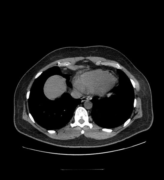 File:Chromophobe renal cell carcinoma (Radiopaedia 84337-99644 Axial non-contrast 4).jpg