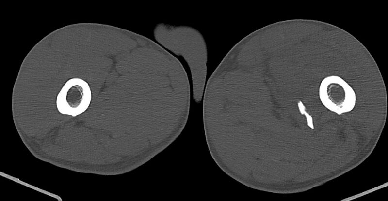 File:Chronic osteomyelitis (with sequestrum) (Radiopaedia 74813-85822 Axial non-contrast 74).jpg