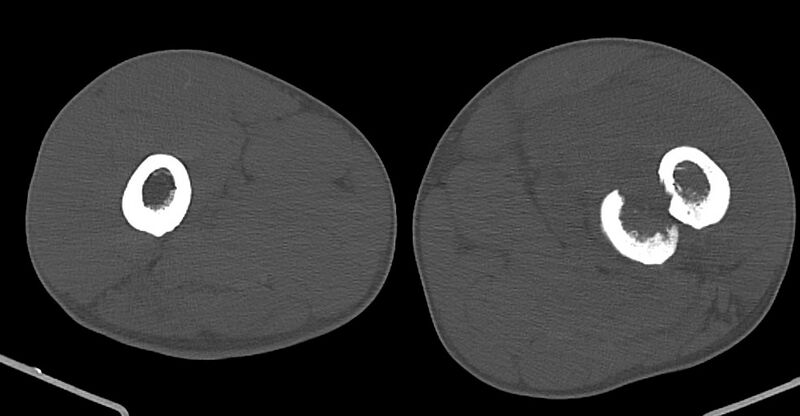 File:Chronic osteomyelitis (with sequestrum) (Radiopaedia 74813-85822 Axial non-contrast 81).jpg