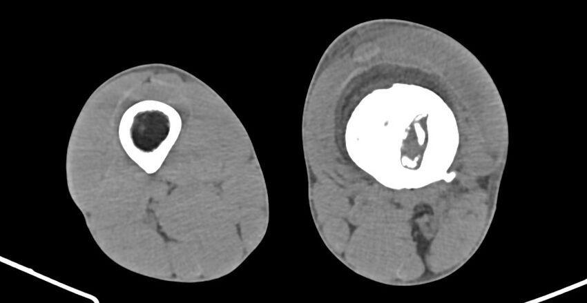 Chronic osteomyelitis (with sequestrum) (Radiopaedia 74813-85822 D 140).jpg