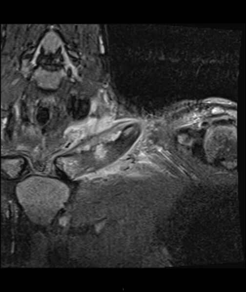 File:Chronic reactive multifocal osteomyelitis (CRMO) - clavicle (Radiopaedia 56406-63071 Coronal STIR 7).jpg
