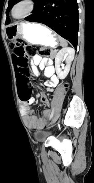 File:Chronic small bowel volvulus (Radiopaedia 75224-86322 C 51).jpg