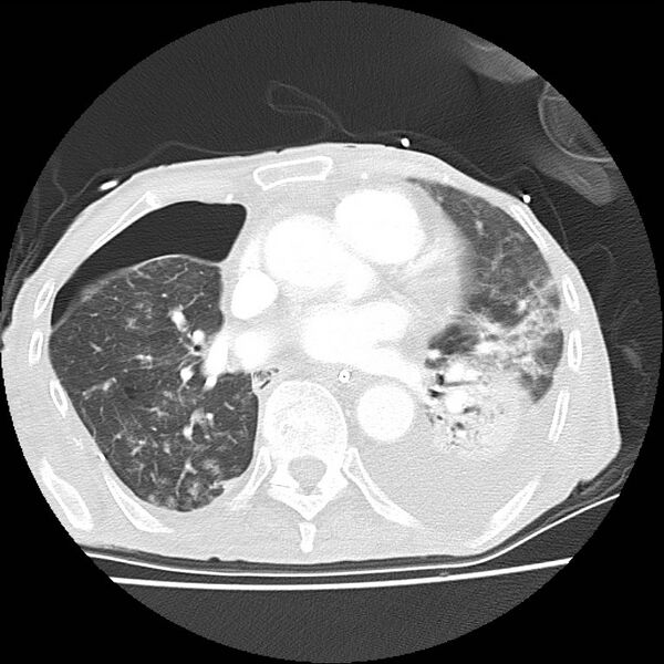 File:Clagett thoracotomy with bronchopleural fistula (Radiopaedia 29192-29587 Axial lung window 28).jpg
