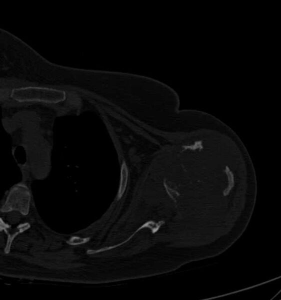 File:Clear cell chondrosarcoma - humerus (Radiopaedia 63104-71612 Axial bone window 48).jpg