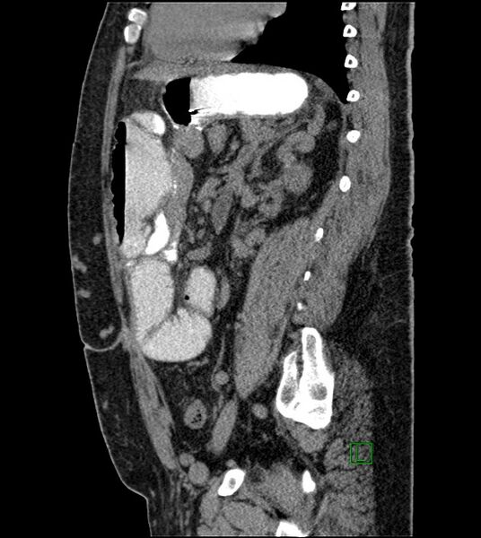 File:Closed-loop small bowel obstruction-internal hernia (Radiopaedia 78439-91096 C 61).jpg