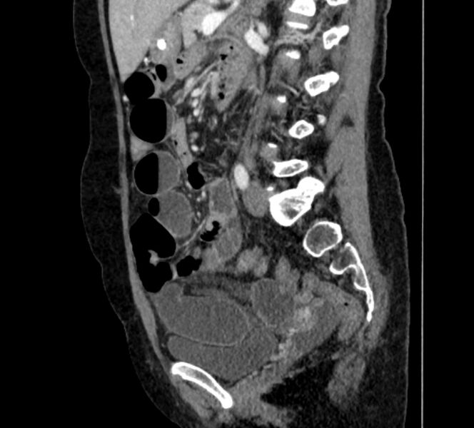 File:Closed loop small bowel obstruction (Radiopaedia 71211-81508 C 90).jpg