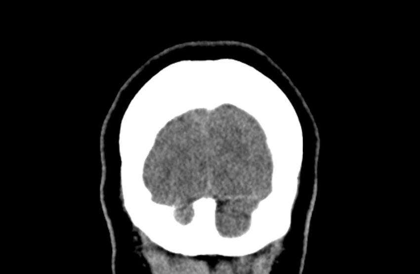 Colloid cyst (Radiopaedia 53180-59146 Coronal non-contrast 81).jpg