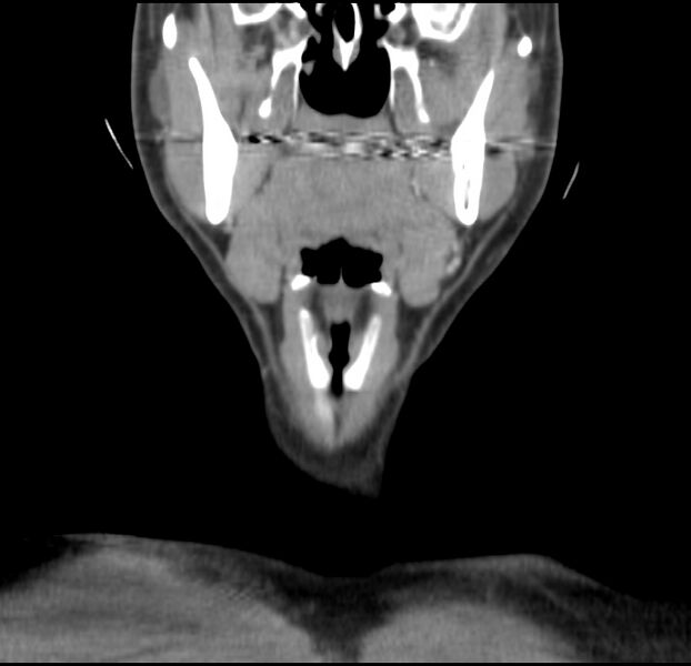 File:Colloid cyst of thyroid (Radiopaedia 22897-22923 Coronal C+ delayed 21).jpg