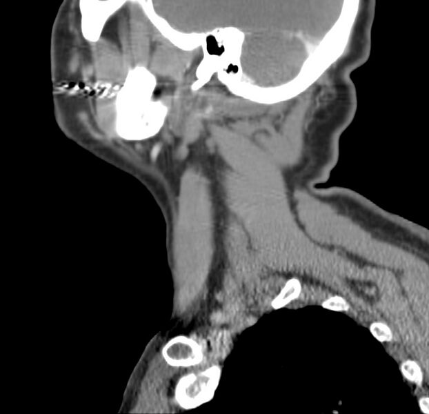 File:Colloid cyst of thyroid (Radiopaedia 22897-22923 Sagittal C+ delayed 45).jpg