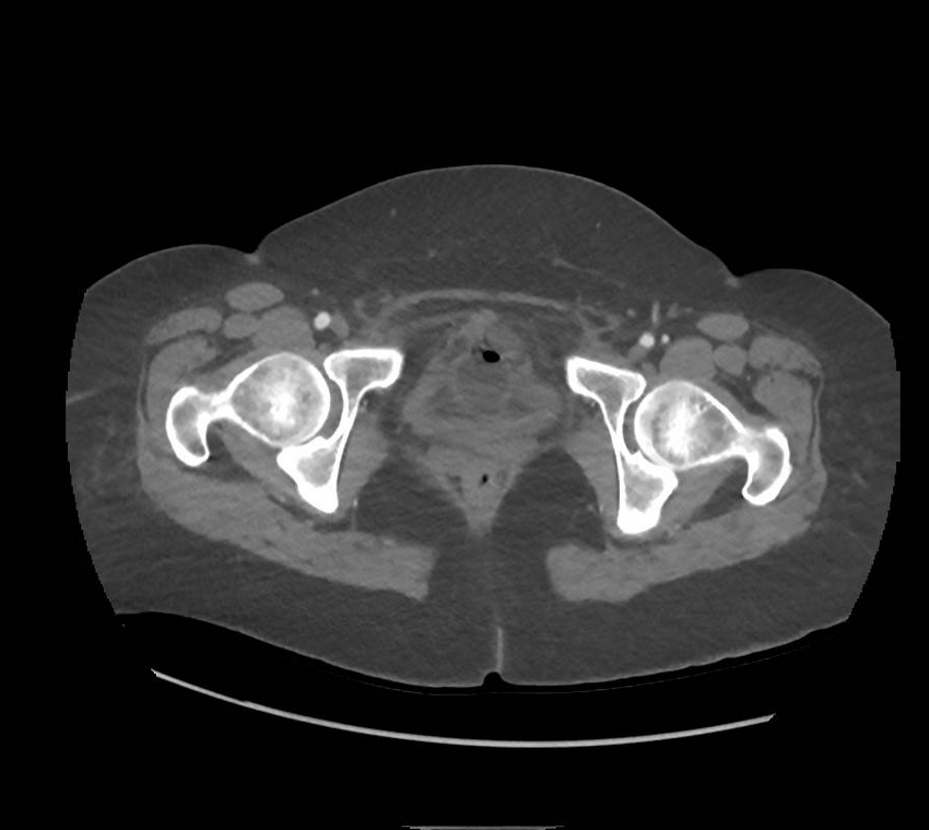 Colonic pseudo-obstruction (Radiopaedia 79752-92980 A 184).png