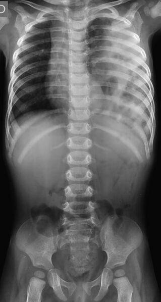 File:Congenital diaphragmatic hernia (Radiopaedia 67933).jpg