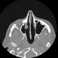 Nasal polyp (Radiopaedia 11657-12020 Axial bone window 1).jpg