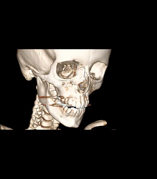 File:Nasoorbitoethmoid fracture (Radiopaedia 90044-107205 3D VRT 12).jpg