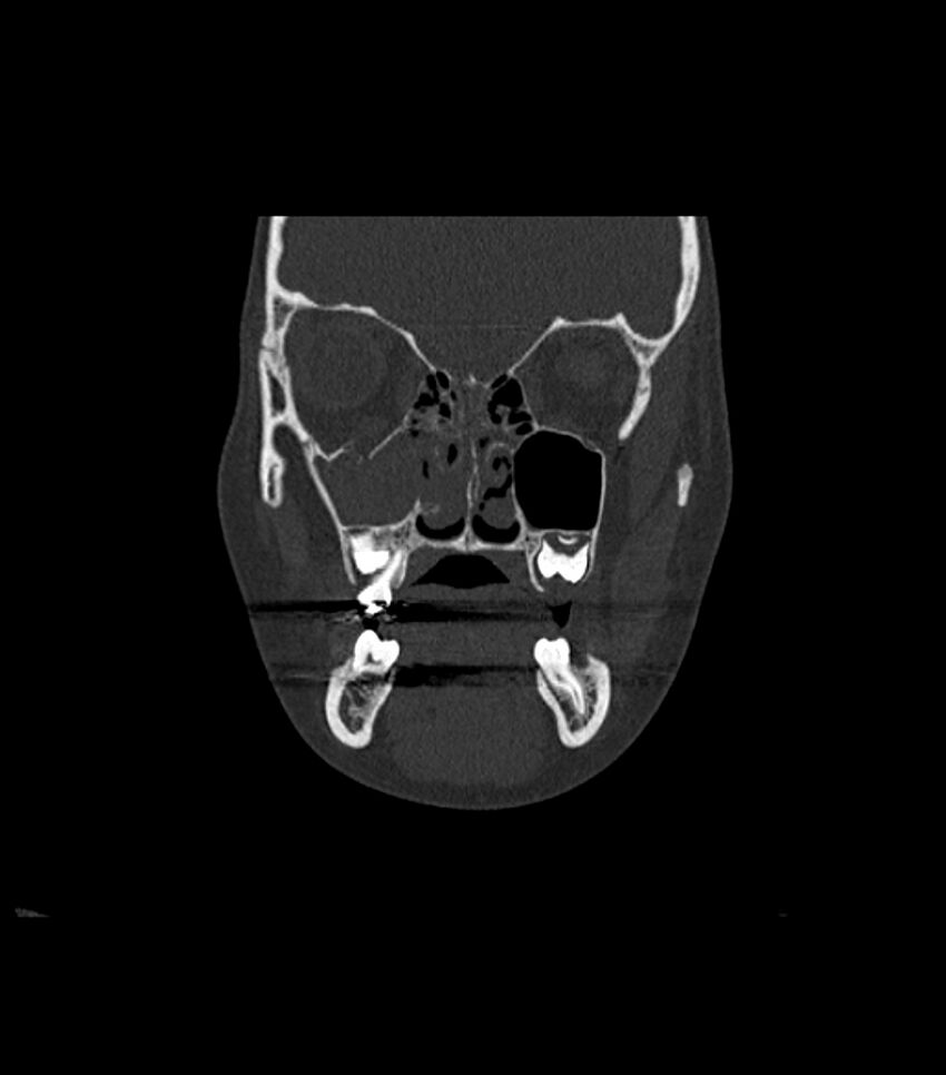 Nasoorbitoethmoid fracture (Radiopaedia 90044-107205 Coronal bone window 51).jpg