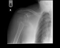 Neck of humerus fracture (Radiopaedia 8781-9582 A 1).jpg