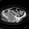 Nerve sheath tumor - malignant - sacrum (Radiopaedia 5219-6987 A 6).jpg