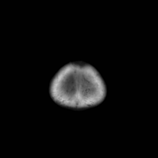 File:Neuroblastoma with skull metastases (Radiopaedia 30326-30958 Coronal bone window 3).jpg