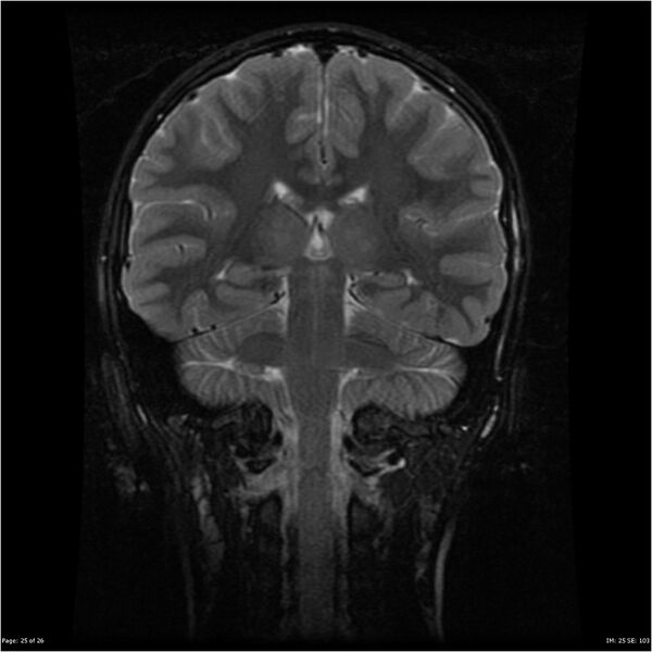 File:Neurofibromatosis type 1 (Radiopaedia 22541-22564 Coronal T2 fat sat 16).jpg