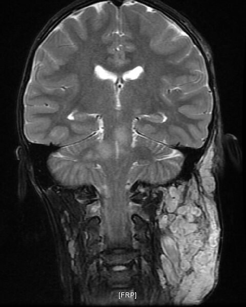 File:Neurofibromatosis type 1 (Radiopaedia 6954-8063 Coronal T2 9).jpg