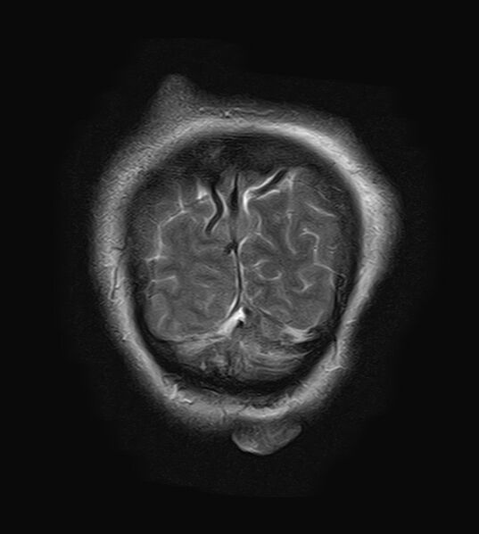 File:Neurofibromatosis type 2 (Radiopaedia 66211-75401 Coronal T2 24).jpg