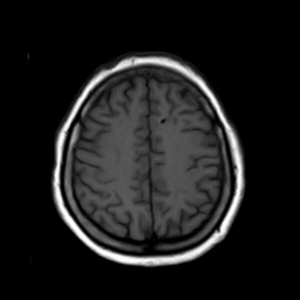 File:Neurofibromatosis type 2 (Radiopaedia 67470-76871 Axial T1 18).jpg