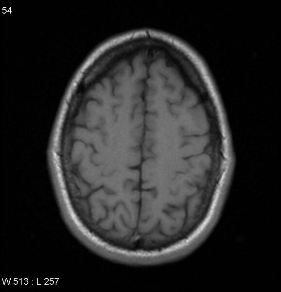 File:Neurosarcoidosis (Radiopaedia 10930-17204 Axial T1 16).jpg