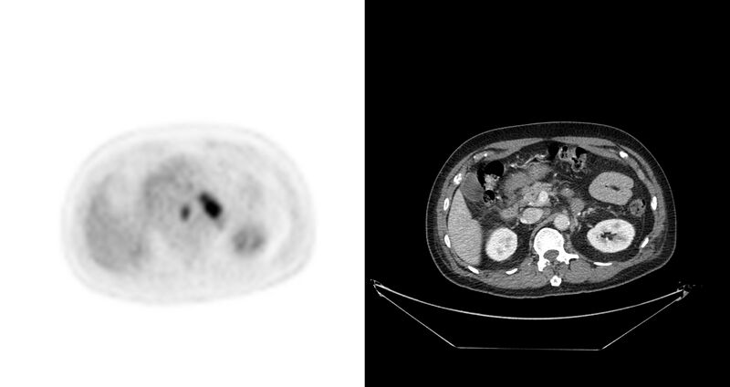 File:Non-Hodgkin lymphoma involving seminal vesicles with development of interstitial pneumonitis during Rituximab therapy (Radiopaedia 32703-33675 axial PET CT 32).jpg