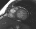 Non-compaction of the left ventricle (Radiopaedia 69436-79314 Short axis cine 101).jpg