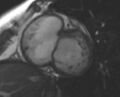 Non-compaction of the left ventricle (Radiopaedia 69436-79314 Short axis cine 178).jpg
