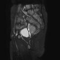 Non-puerperal uterine inversion (Radiopaedia 78343-90983 Sagittal T2 fat sat 6).jpg