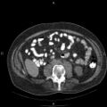 Non Hodgkin lymphoma in a patient with ankylosing spondylitis (Radiopaedia 84323-99624 Axial non-contrast 46).jpg