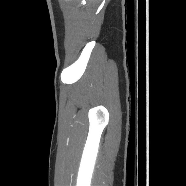 File:Normal CT angiogram of pelvis (Radiopaedia 45390-49430 C 12).jpg